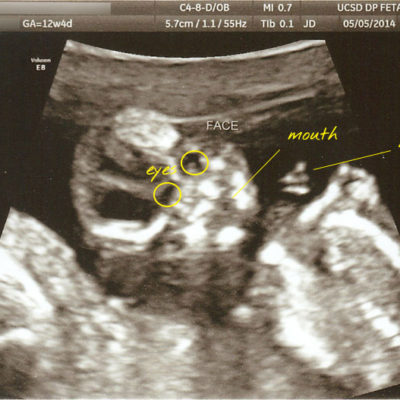 12 Weeks / Nuchal Scan